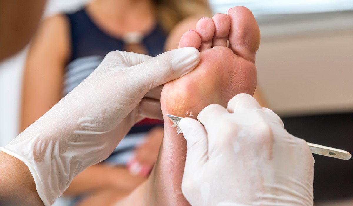 Clínica con tratamiento de callos Valencia Clínica con tratamiento de callos Valencia